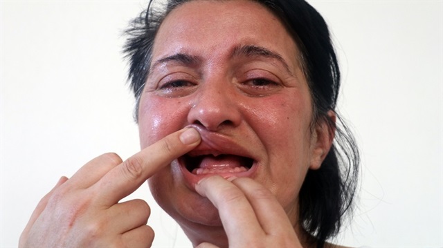 Antalya haberleri: Beyaz diş hayaliyle 32 dişinden olan kadının başı…