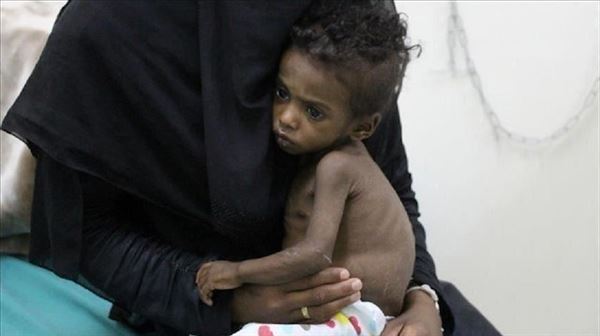الصحة العالمية: 15 ألف طفل يمني يعانون سوء تغذية حاد